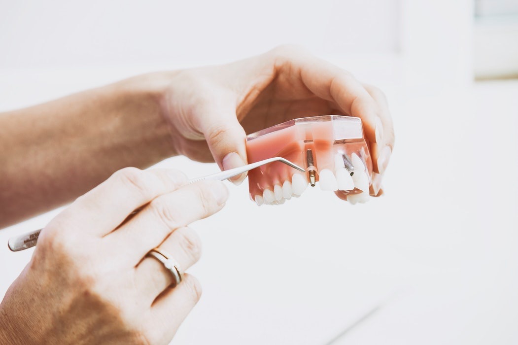 How Painful is Dental Implant Surgery?