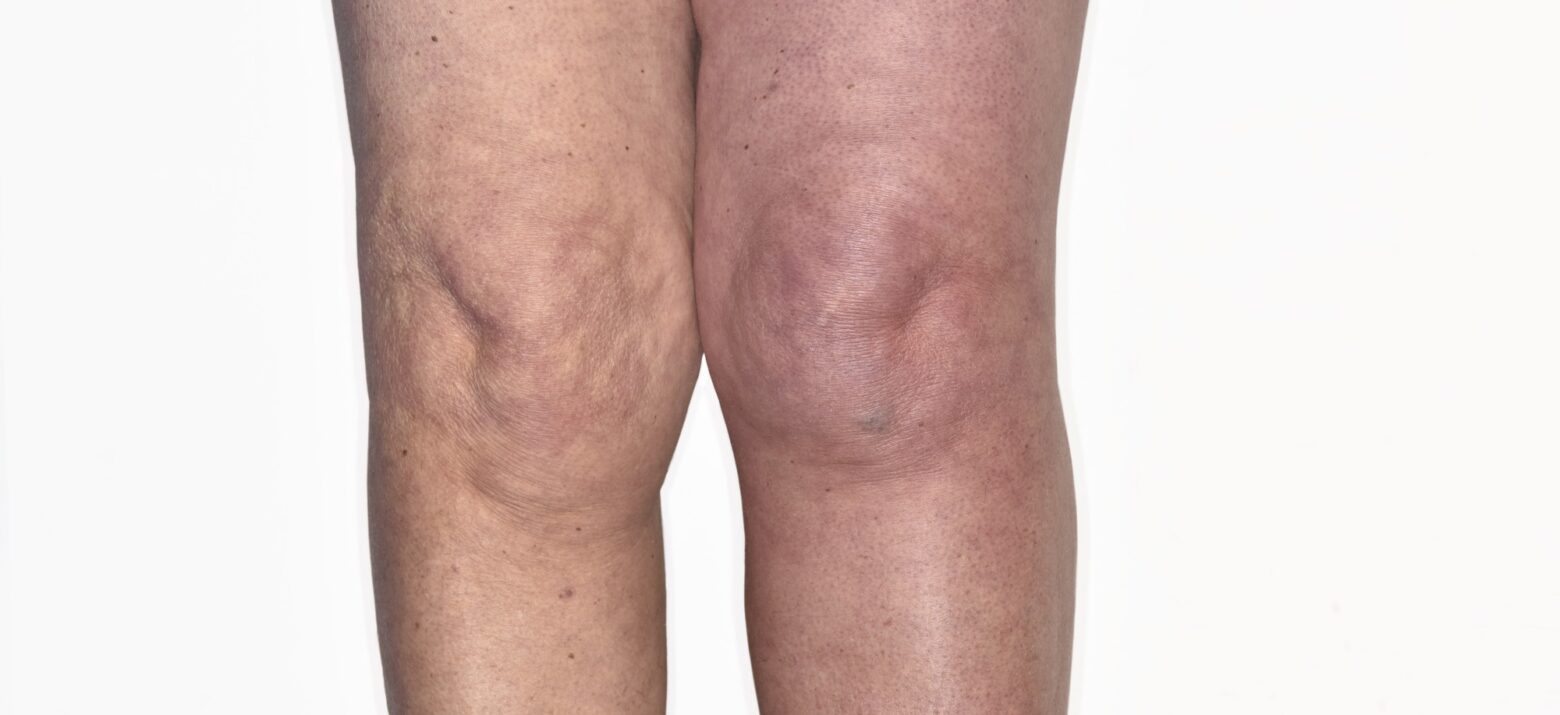 Legs in deep vein thrombosis