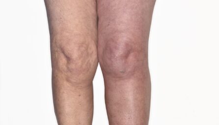Legs in deep vein thrombosis