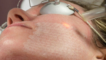 Erbium laser face ama regenerative medicine